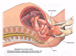 Birth Injury - Shoulder Dystocia with Brachial Plexus Injury Caused by Sacrum