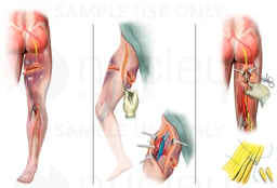 Right Thigh Crush Injury and Sciatic Nerve Damage with Surgical Nerve Graft Repair