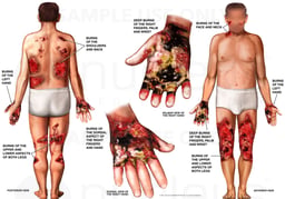 Initial Burn Injuries