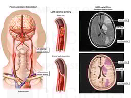 Post accident brain stroke injuries