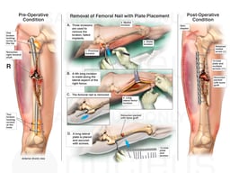 Open Reduction and Internal Fixation of Right Femoral Shaft