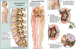 Lumbar Spine Injuries