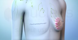 What Happens During a Modified Radical Mastectomy? 