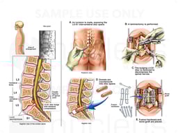 L5-S1 Spinal Injury with Future Posterior Spinal Fusion