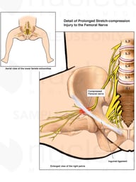 Femoral Nerve Injury Secondary to Prolonged Dorsal Lithotomy Position