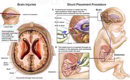 Hydrocephalus and Intraventricular Hemorrhage with Placement of Ventriculoperitoneal Shunt
