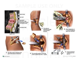 L1 Compression Fracture with Lateral Fusion T12-L2