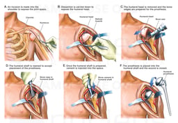 Total Shoulder Arthroplasty with Joint Replacement