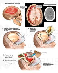 Brain Injury with Surgical Craniotomy