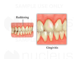 Gingivitis
