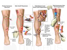 Continuation of Multiple Surgeries