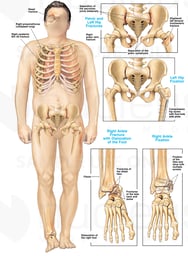 Male Figure with Fractures and Fixation of Pelvic and Ankle Injuries