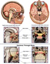 Brain Tumor (Craniopharyngioma) with Compression of Adjacent Structures