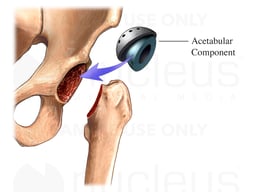 Total Hip Replacement-Acetabular Component