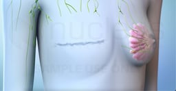 What Happens During a Total, or Simple, Mastectomy? 