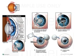 Corneal Scarring and Cataract with Surgical Keratoplasty and Lens Replacement