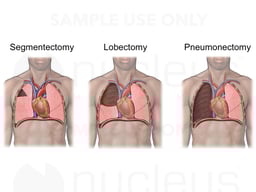 Lung Surgeries