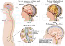 Puncture with Subsequent Brain Damage