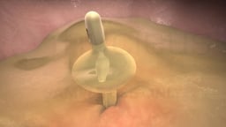 Removal of Foley Catheter (Male)