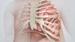 Congenital Diaphragmatic Hernia Repair (Pediatric)