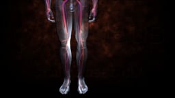 Deep Vein Thrombosis (DVT) and Pulmonary Embolism