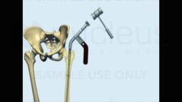 Femoral Fracture Fixation Surgery: Intramedullary Nail