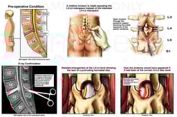 L4-5 Disc Herniation with Incorrect Surgical Repair