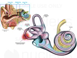 Dehiscence of Semicircular Canal