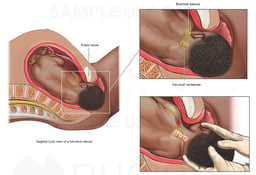 Shoulder Dystocia with Brachial Plexus Injury