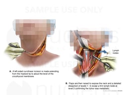 Cancer Surgery: Neck Dissection