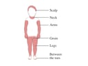 Areas of Ringworm Rash