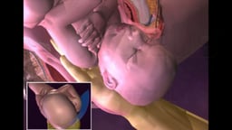 Birth Injury Correction for Shoulder Dystocia: Woods Corkscrew Maneuver