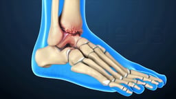 Lateral View of Arthritis in Ankle Joint