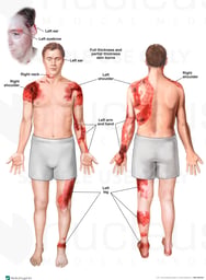 Burn Injuries to the Face, Shoulders, Arm and Leg