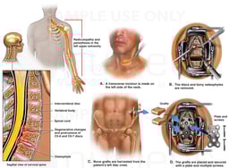 Cervical Spine Injuries with Surgical Fusion