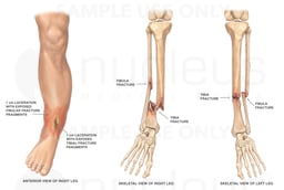 Bilateral Lower Leg Fractures