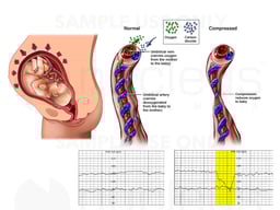 Compressed Umbilical Cord