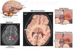 Brain Injury
