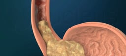 Understanding Gastroesophageal Reflux Disease (GERD)