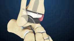 Total Ankle Replacement with Prosthetic Components