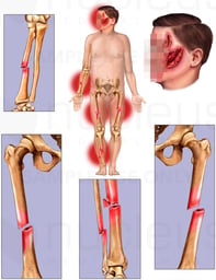 Multiple Orthopedic Injuries Sustained During MVA