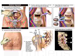 L4-5 and L5-S1 Lumbar Spine Anterior and Posterior Surgeries