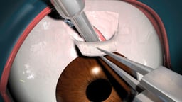 Glaucoma Surgery Condensed