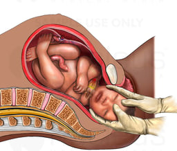 Normal Delivery with Nerve Injury, Cut-away View