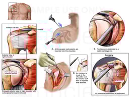 Right Shoulder Injuries with Surgeries