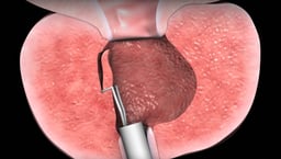 What is TURP for Benign Prostatic Hyperplasia (BPH)?