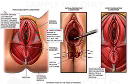 Fourth Degree Episiotomy with Recto-vaginal Fistula