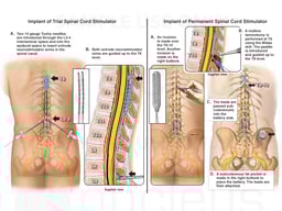 Spinal Cord Stimulator to Treat Continued Lumbar Pain