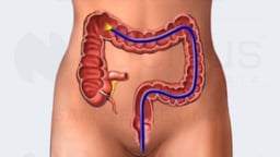 Lower GI Endoscopy (Colonoscopy)