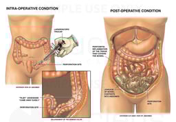 Laparoscopic Surgery with Bowel (Large Intestine) Perforation